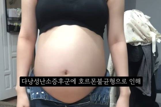 Kwon shows her belly in a video where she detailed her experience of terminating a nine-month pregnancy, uploaded to YouTube in 2024 then deleted. [SCREEN CAPTURE]