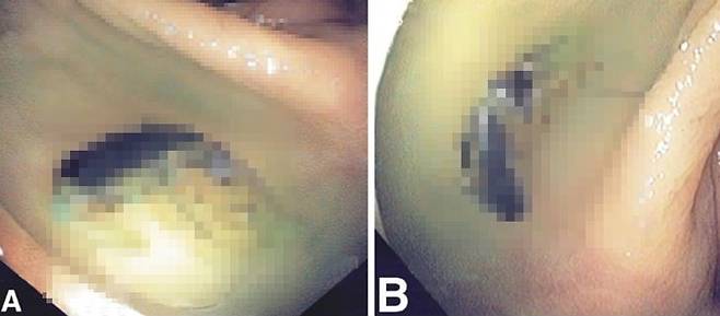 장 속에서 온전한 상태로 살아있는 벌레가 발견되기도 한다/사진=Gastrointestinal Endoscopy