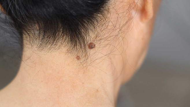 갑자기 생긴 쥐젖은 단순 피부 질환이 아닌, 당뇨 전단계 증상일 수 있다|출처: 클립아트코리아