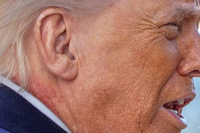 도널드 트럼프 미국 대통령이 지난달 27일 워싱턴 백악관에서 마린원 헬기 탑승 전 기자들과 이야기 하고 있다. 그의 오른쪽 목에 붉은 반점이 보이고 있다. AP뉴시스