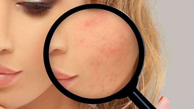 여드름 흉터는 피부 구조에 영구적 변화를 남길 수 있어 초기부터 적극적인 관리가 필요하다｜출처: 게티이미지뱅크