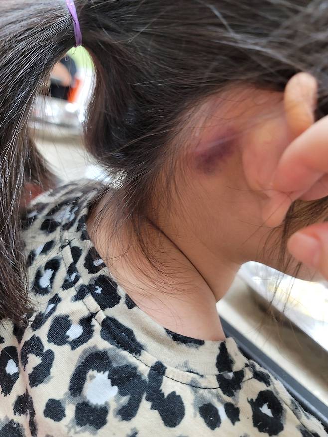 서윤(가명)이 귀 뒤 상처. 독자 제공