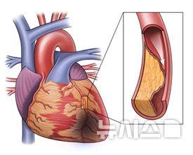 [서울=뉴시스] 협심증과 심장혈관협착. (사진= 서울아산병원 제공)