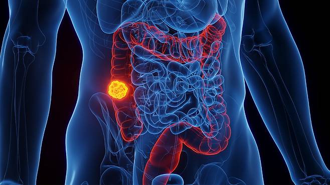 大腸がんは関心を持って管理すれば十分に予防できる疾患である｜出典：クリップアートコリア