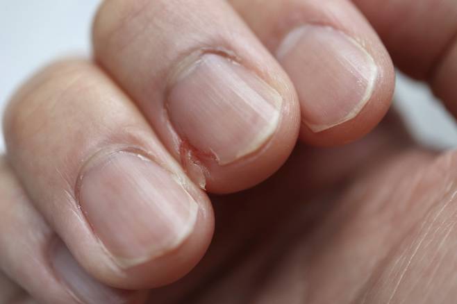 손톱이 잘 깨지면 뼈 건강도 약화됐다는 것을 의미하는 신호로 여겨질 수 있다. 사진=게티이미지뱅크