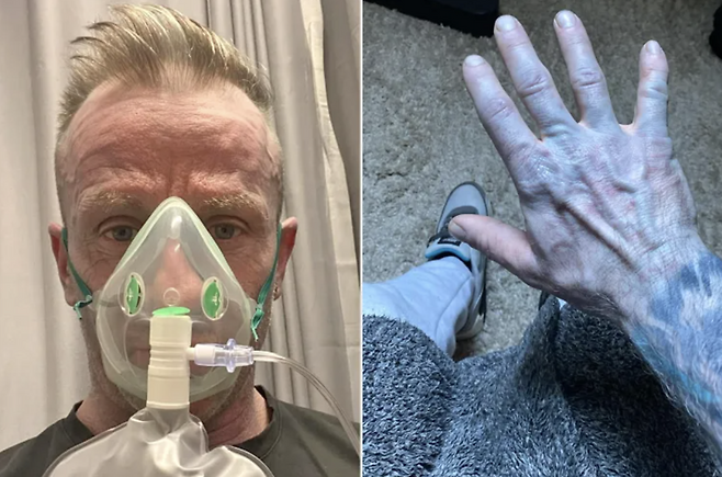 몸이 파란색으로 변한 걸 발견한 뒤 병원에 긴급 이송돼 산소 마스크까지 착용한 남성의 사연이 전해졌다. /사진=더선 캡처