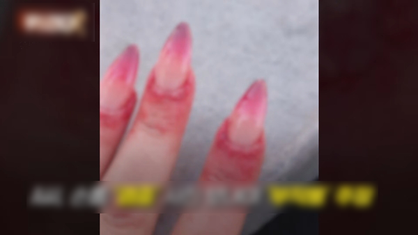 ▲ 챗GPT로 네일아트 시술 부작용이 생긴 것처럼 조작한 사진 [연합뉴스TV 캡처]&nbsp;&nbsp;