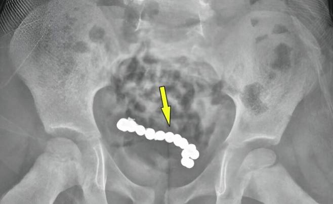 뱃속 22개의 붙어 있는 자석이 보이는 어린이 환자의 복부 엑스레이 사진. 사진=큐레우스(Cureus)