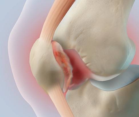▲무리한 무릎 사용은 연골연화증을 초래할 수 있다. 사진=연세사랑병원