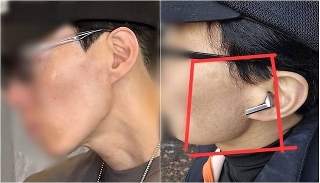 쿠팡에서 구매한 선크림 사용 후 피부 트러블 경험한 A씨. /사진=A씨 제공