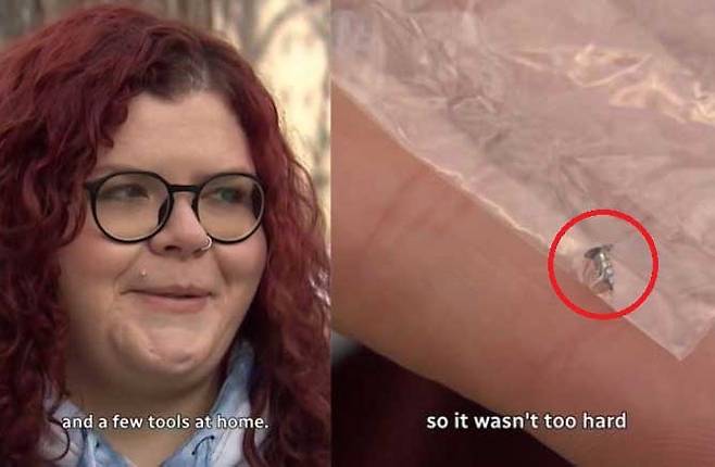 금속 나사가 머리 피부를 뚫고 밖으로 튀어나왔는데도, 해당 병원에서는 이를 단순한 혹으로 봤다는 황당한 사연이 전해졌다. [틱톡 ‘cbcasksnews’ 채널 캡처]