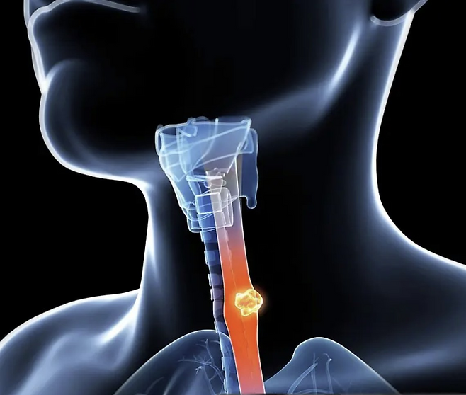 식도암 수술 후 다른 암이나 호흡기질환으로 사망할 위험이 높아지므로 주의해야 한다는 연구 결과가 발표됐다. 게티이미지