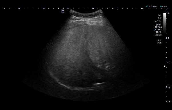 13세 남아의 간 초음파 사진. 간이 정상보다 밝게 보이고 깊은 부위가 잘 관찰되지 않는 모습으로, 지방이 축적될 때 나타나는 전형적인 모습. 중등도 지방간 소견./사진=서울대병원 영상의학과 최재원·소아청소년과 심정옥 교수 도움