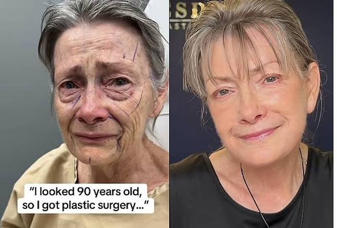 안면거상 수술을 받은 70세 여성의 수술 전(왼쪽)과 수술 후(오른쪽) 모습. (사진출처: 틱톡)/뉴시스