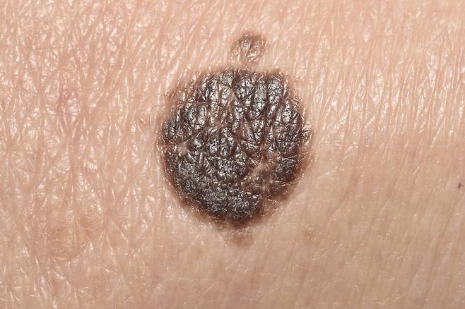 양성종양으로서의 특성을 이해하면 예방과 치료에 도움이 된다./사진=클립아트코리아