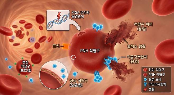 PNH는 적혈구를 보호하는 단백질이 결핍돼, 우리 몸의 면역세포의 하나인 보체 공격에 노출, 적혈구가 깨지는 질환.