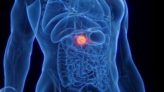 세브란스병원은 췌장암 환자의 혈액검사를 기반으로 초기 간 전이 위험을 예측하는 AI 모델을 개발해 활용 가능성을 확인했다. 클립아트코리아