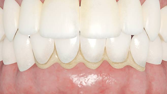 구강외과 전문의가 치석을 방치하는 습관의 위험성을 강조했다./사진=클립아트코리아