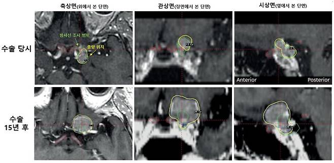 55세 여성 환자의 시신경 인접 수막종 수술 당시(상단)와 15년 후(하단) MRI 영상. /서울대병원 제공
