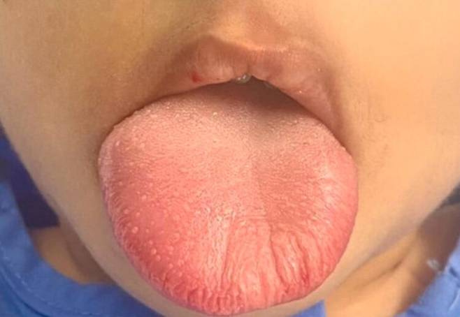 16개월 아기에게 발생한 거대설증. 사진=구강악안면외과 사례(Oral and Maxillofacial Surgery Cases)