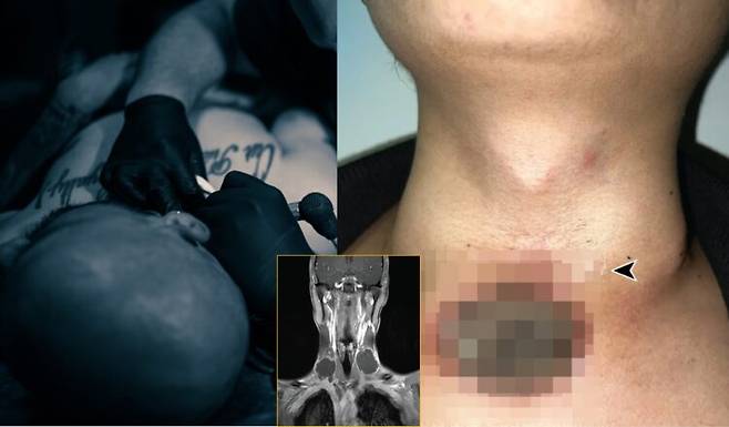 목에 문신(타투)을 새겼다가 수개월이 지나 피부 조직이 검게 썩어 궤양이 발생한 사례가 보고됐다. 사진=왼쪽은 게티이미지뱅크/ 미국의학회 이비인후과학·두경부외과학회지 사례 / 코메디닷컴 편집