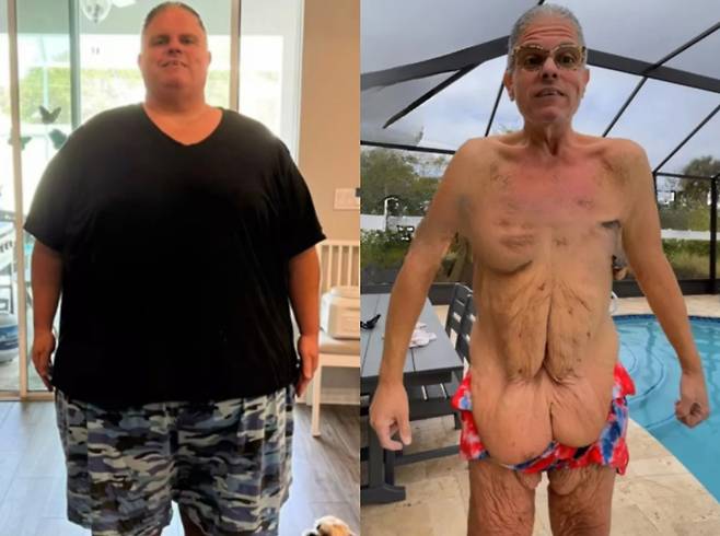 미국의 한 40대 남성이 230kg 감량 후 겪은 부작용을 토로했다./사진=더 선