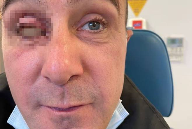 영국의 한 40대 남성이 가족들과 휴가를 갔다가 눈에 상처를 입고 한 쪽눈을 잃었다. 출처=더 미러