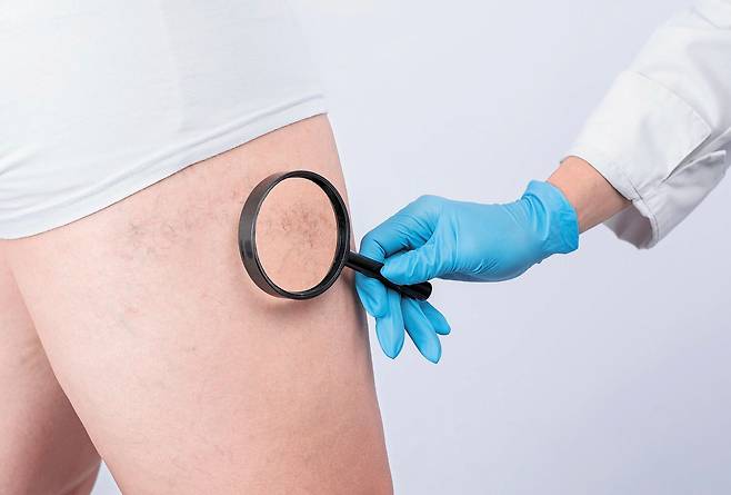 하지정맥류·여유증 등의 질환은 외형 변화를 일으켜 옷차림이 가벼워지는 봄철에 스트레스를 유발할 수 있다.