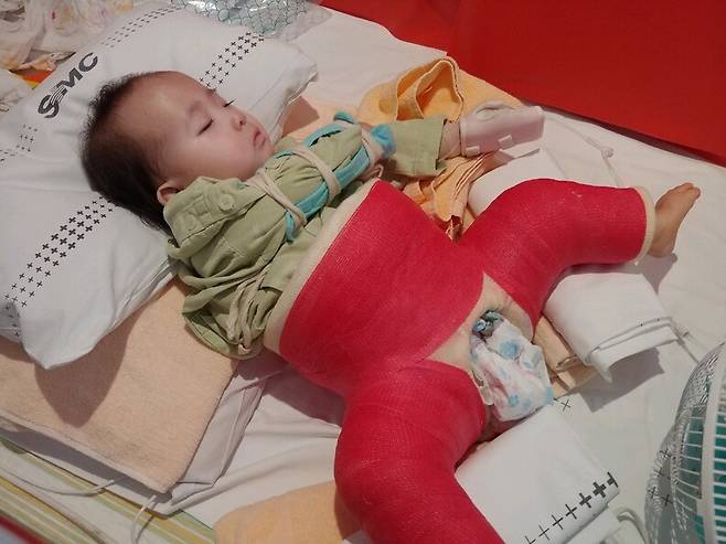 생후 14개월 당시 고관절 수술을 받고 회복 중인 미지의 모습. 미지는 태어나자마자 항문 재건 수술, 구개열 수술, 대장과 소장을 분리하는 수술, 고관절 수술, 귀 튜브 삽입 수술, 중이염 수술을 겪었다. 가족 제공
