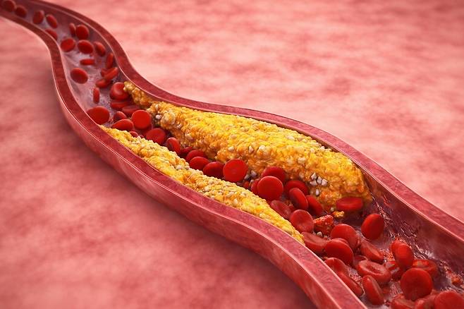 혈관 콜레스테롤 [자료 이미지]