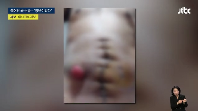 이주 노동자가 상해 피해를 입은 모습. [JTBC 보도화면 갈무리]