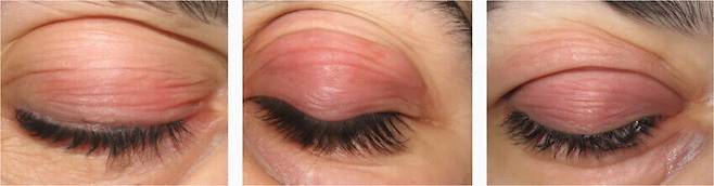 연구진은 청색광 노출로 인한 색소 침착 현상을 ‘빅소니매니아’란 가짜 질병의 특성으로 규정했다. 논문 갈무리