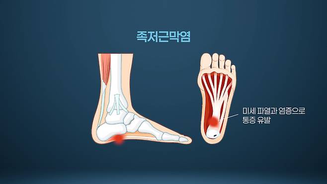 족저근막염 발생 부위 /서울경제TV ‘지금 명의’ 캡처