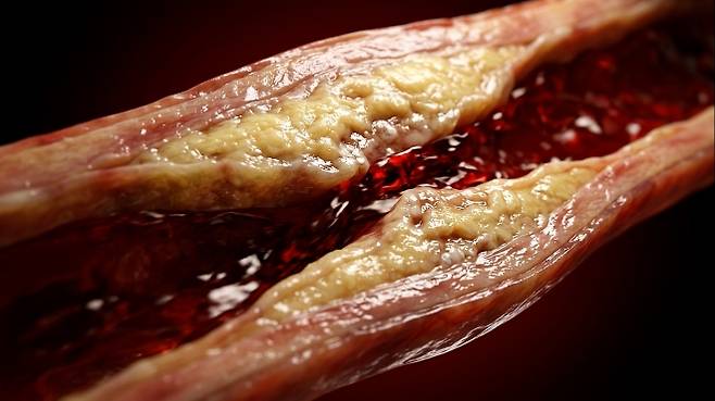 동맥경화증 관련 AI 생성 이미지