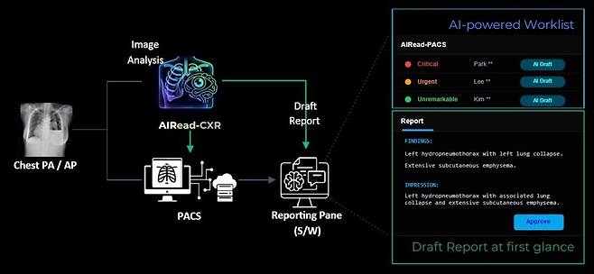 AIRead-CXR 구조. 숨빗AI