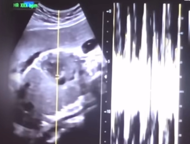36주 차 산모 권모씨의 유튜브 동영상에 담겨 있던 초음파 사진과 심박 그래프. 서울중앙지검 제공