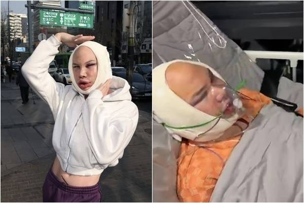 핀란드의 30대 남성이 서울에서 안면윤곽·리프팅 수술을 받은 뒤 극심한 부기로 일시적으로 시력을 상실했다는 외신 보도가 나왔다. 조니 헤셀그렌 인스타그램(@hesselgrenjoni) 캡처