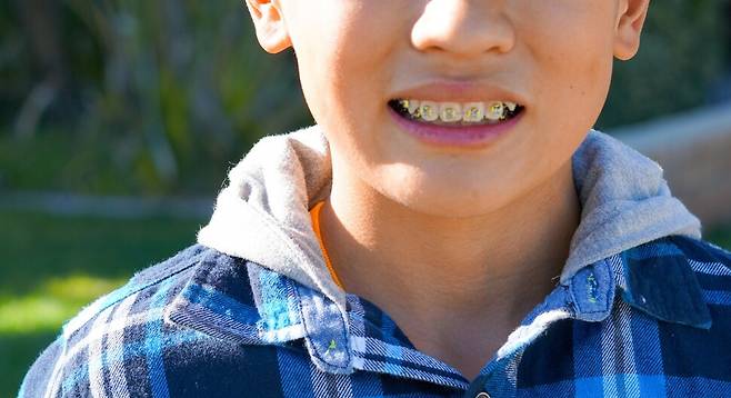 성장기 어린이의 치아교정은 단순히 치아를 가지런히 배열하는 것만이 아니라 위턱과 아래턱, 얼굴뼈의 성장까지 균형적으로 조절해 부정교합도 교정한다. 그 효과를 극대화하기 위해선 적절한 시기에 치아 검진을 받고 교정을 시작하는 게 좋다. 게티이미지뱅크