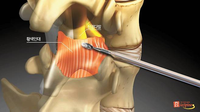 비후된 황색인대를 제거하는 추간공확장술 모식도.