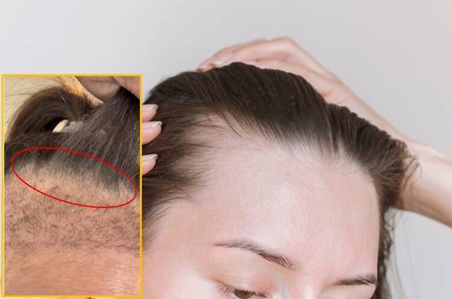 모발 이식 수술을 받은 한 미국 여성이 이식 부위와 그 주변에서 새로 자라는 머리카락이 원래 색이 아닌 흰색으로 자라는 부작용을 겪고 있다. 배경사진=게티이미지뱅크/좌측 하단 사진=SNS