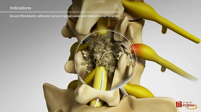 디스크나 주변 조직에서 흘러나온 생화학적 염증 유발물질이 척추관이나 추간공 주변에 쌓이면서 형성된 미세한 섬유성 유착.