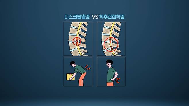 허리디스크와 척추관협착증 / 서울경제TV ‘지금 명의’ 캡처