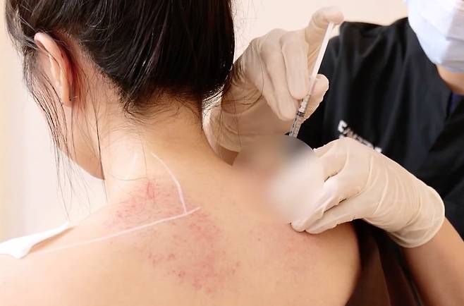 상부 승모근을 보톡스로 최대한 퇴축시켜 가녀린 상체 라인을 만드는 시술이 급증했다. 예비 신부 사이에선 웨딩 촬영과 결혼식 전 필수 코스처럼 여겨진다. /조선일보DB