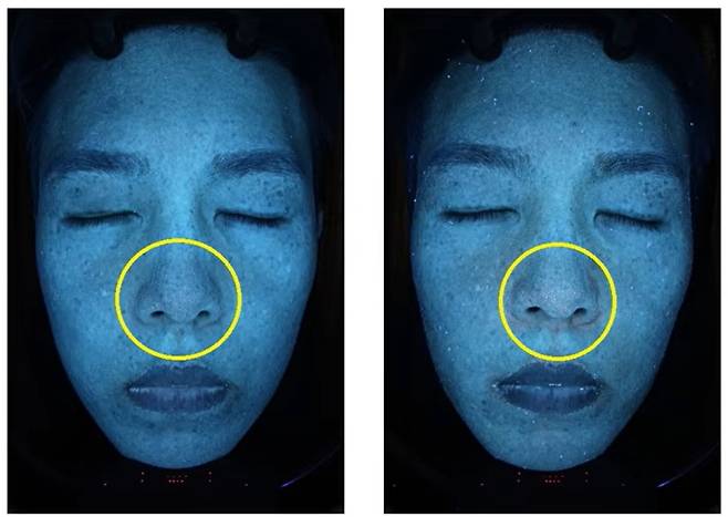 피부과 전문의 이승주 원장이 피부에 해로운 음식을 일주일 동안 먹어본 후 얼굴에 피지와 포르피린(여드름균이 대사 과정에서 생성하는 물질)이 늘어났다고 설명하는 상황.[유튜브 채널 ‘피친남 이승주’ 캡처]