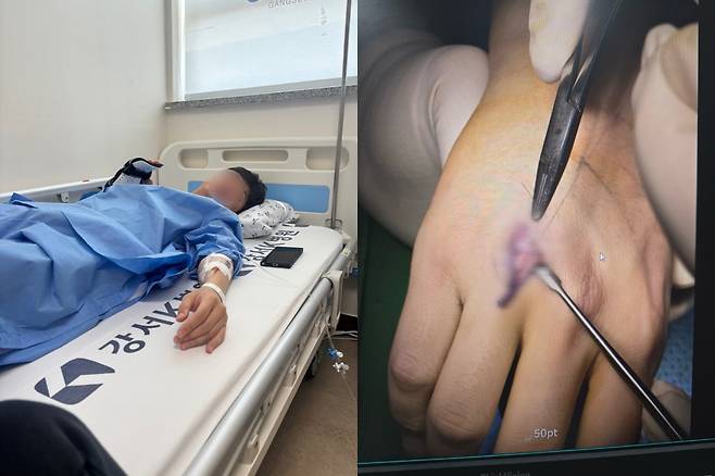 양주 출입국·외국인사무소 단속팀 직원 김모씨(32)가 단속 과정에서 손등 인대가 파열되는 부상을 입어 입원한 모습.  /사진=독자 제공