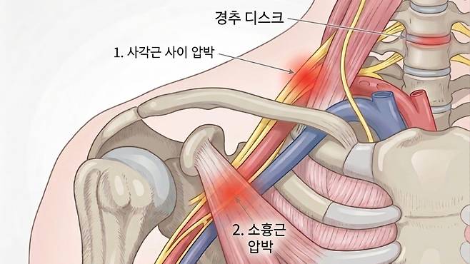 흉곽출구증후군 신경 압박 부위 | 출처: 박성만 원장, Gemini 생성