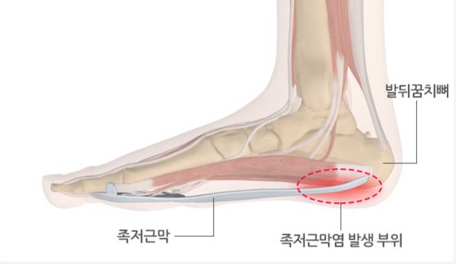 족저근막염 발생 부위를 설명한 그림. /자료=국가건강정보포털