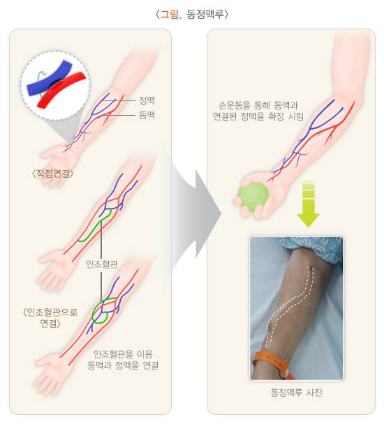 동정맥루. /자료=국가건강정보포털