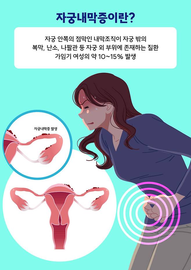 자궁내막증 개요 인포그래픽. 게티이미지뱅크