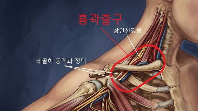 흉곽출구와 상완신경총 | 출처: Gemini 생성